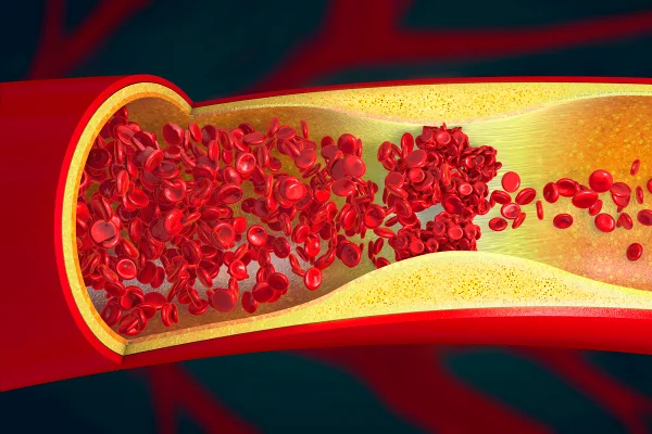 Foto colorida de artéria com placa de gordura - Metrópoles